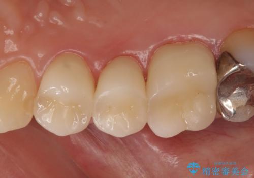 オールセラミッククラウン 咬合痛のある歯の治療の治療後