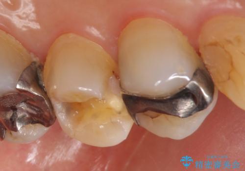 セラミックインレー 脱離した銀歯の治療の治療前