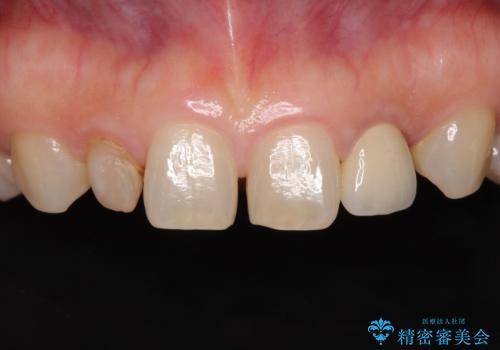 矮小歯のセラミック治療　小さい前歯を自然に仕上げるの治療前