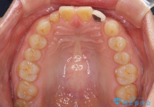 矮小歯のセラミック治療　小さい前歯を自然に仕上げるの治療前
