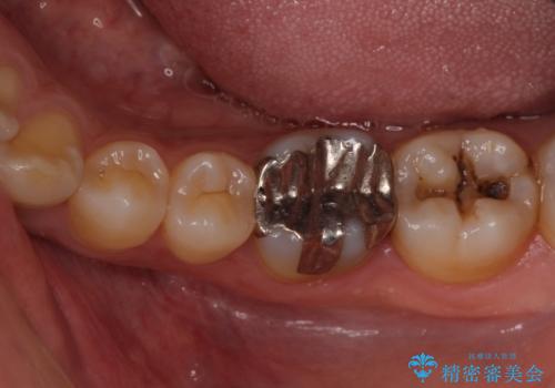 適合不良の銀のつめもの 保険と自費で白くの治療前