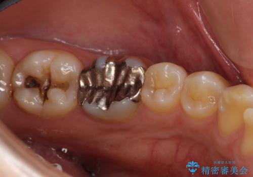 適合不良の銀のつめもの 保険と自費で白くの治療前