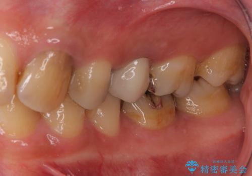 適合不良の銀のつめもの 保険と自費で白くの治療前
