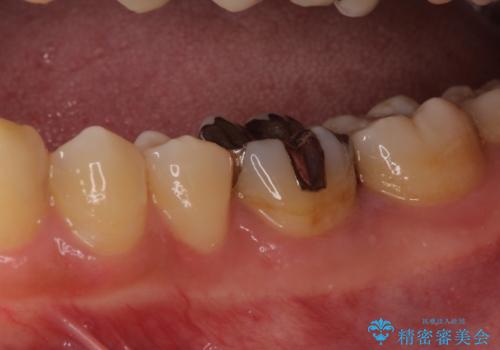 適合不良の銀のつめもの 保険と自費で白くの治療前