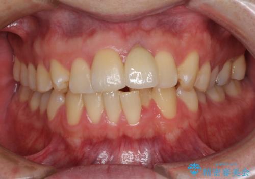 他院で治療したインプラント セラミッククラウンの装着の治療後