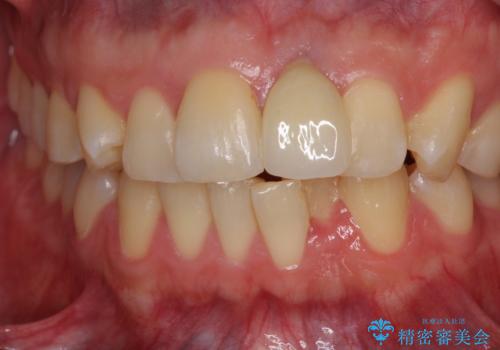 他院で治療したインプラント セラミッククラウンの装着の症例 治療後