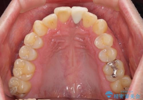 他院で治療したインプラント セラミッククラウンの装着の治療後