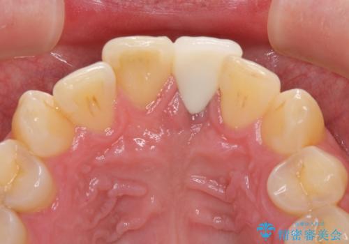 他院で治療したインプラント セラミッククラウンの装着の治療後