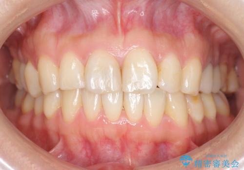 前歯の歯並びが気になる　マウスピース矯正　30代女性の症例 治療後