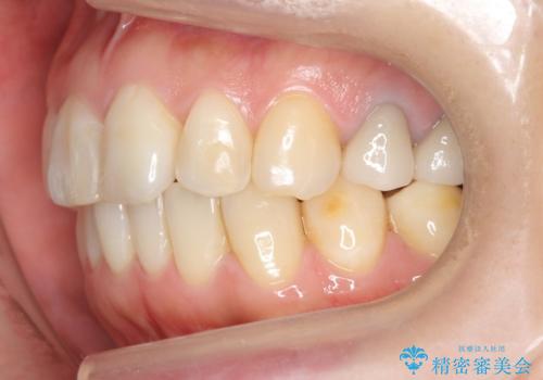 前歯の歯並びが気になる マウスピース矯正 30代女性の治療後