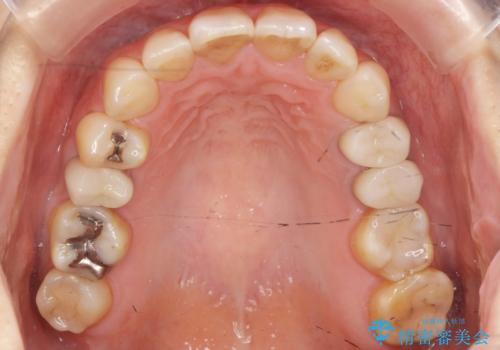 前歯の歯並びが気になる マウスピース矯正 30代女性の治療後