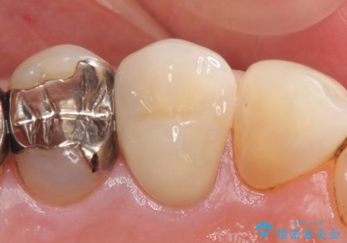 オールセラミッククラウン(エクセレント) 神経まで達してしまった虫歯の治療の治療後