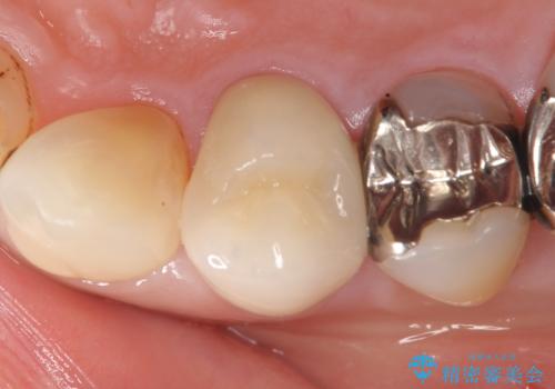 オールセラミッククラウン(エクセレント) 神経まで達してしまった虫歯の治療の治療後