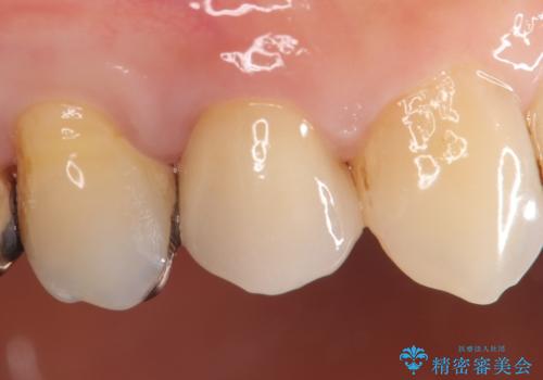 オールセラミッククラウン(エクセレント) 神経まで達してしまった虫歯の治療の治療後
