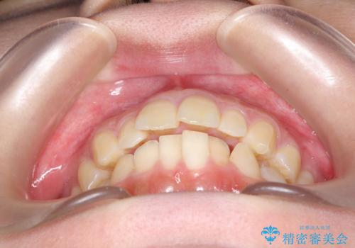出ている前歯をインビザラインにて引っ込めるの治療前