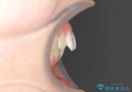 出ている前歯をインビザラインにて引っ込めるの治療前