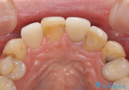 歯肉移植を用いた前歯のオールセラミックブリッジの治療前