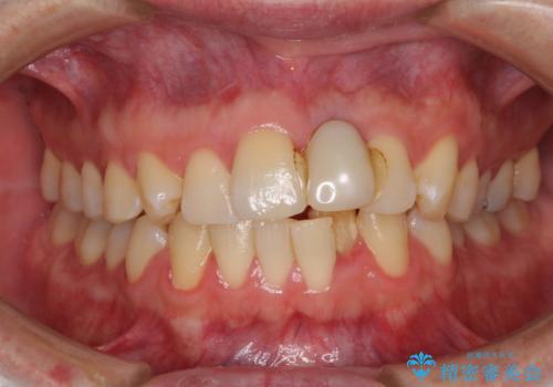 他院で治療したインプラント セラミッククラウンの装着の治療前