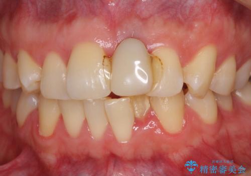 他院で治療したインプラント セラミッククラウンの装着の症例 治療前