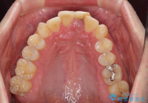 他院で治療したインプラント セラミッククラウンの装着の治療前