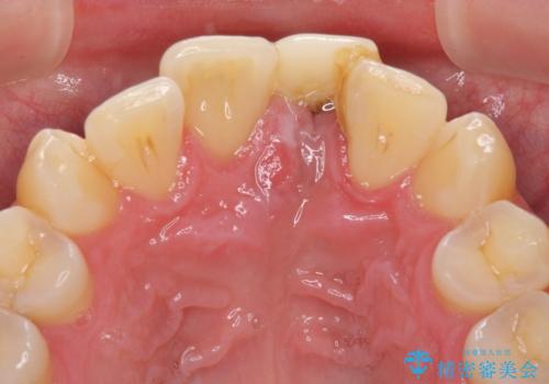 他院で治療したインプラント セラミッククラウンの装着の治療前