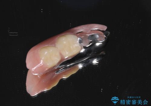 ノンクラスプデンチャー(金属止め具のない入れ歯)で左側の咬合回復の治療後