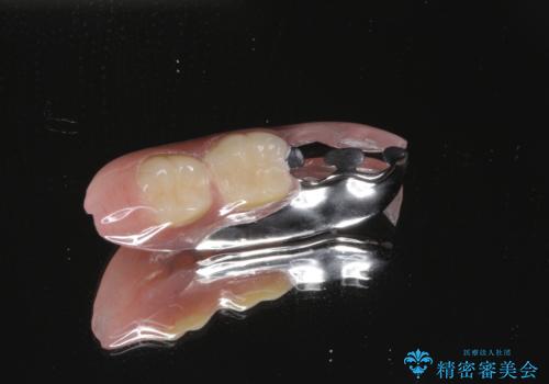 ノンクラスプデンチャー(金属止め具のない入れ歯)で左側の咬合回復の治療中