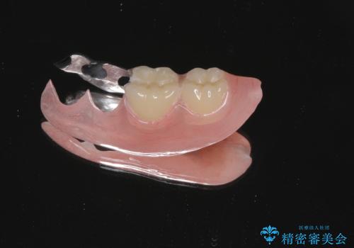 ノンクラスプデンチャー(金属止め具のない入れ歯)で左側の咬合回復の治療前