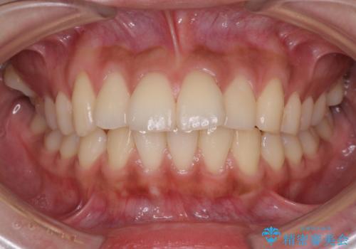 横顔をすっきりさせたい　下の前歯が1本少ない方の変則的な抜歯矯正の治療前