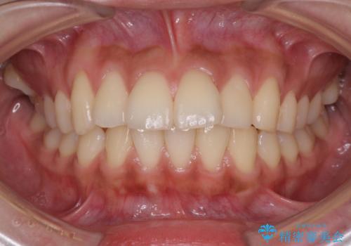横顔をすっきりさせたい 下の前歯が1本少ない方の変則的な抜歯矯正の治療前