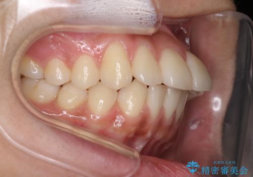 横顔をすっきりさせたい　下の前歯が1本少ない方の変則的な抜歯矯正の症例 治療前