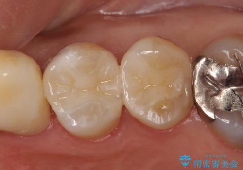セラミックインレー 脱離した銀歯の治療