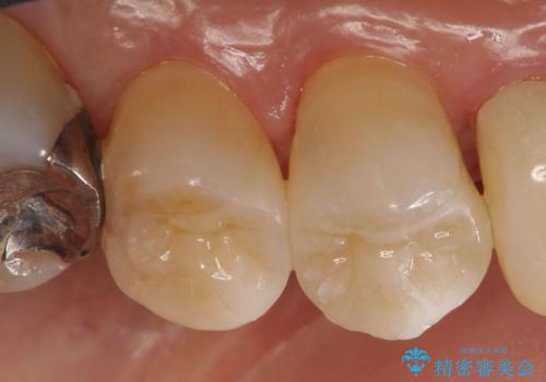 セラミックインレー 脱離した銀歯の治療の治療後