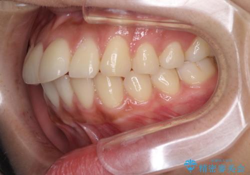 横顔をすっきりさせたい 下の前歯が1本少ない方の変則的な抜歯矯正の治療前