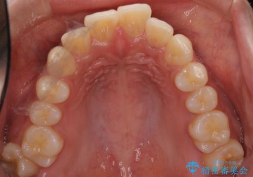 横顔をすっきりさせたい 下の前歯が1本少ない方の変則的な抜歯矯正の治療前