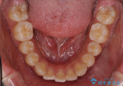 横顔をすっきりさせたい 下の前歯が1本少ない方の変則的な抜歯矯正の治療前