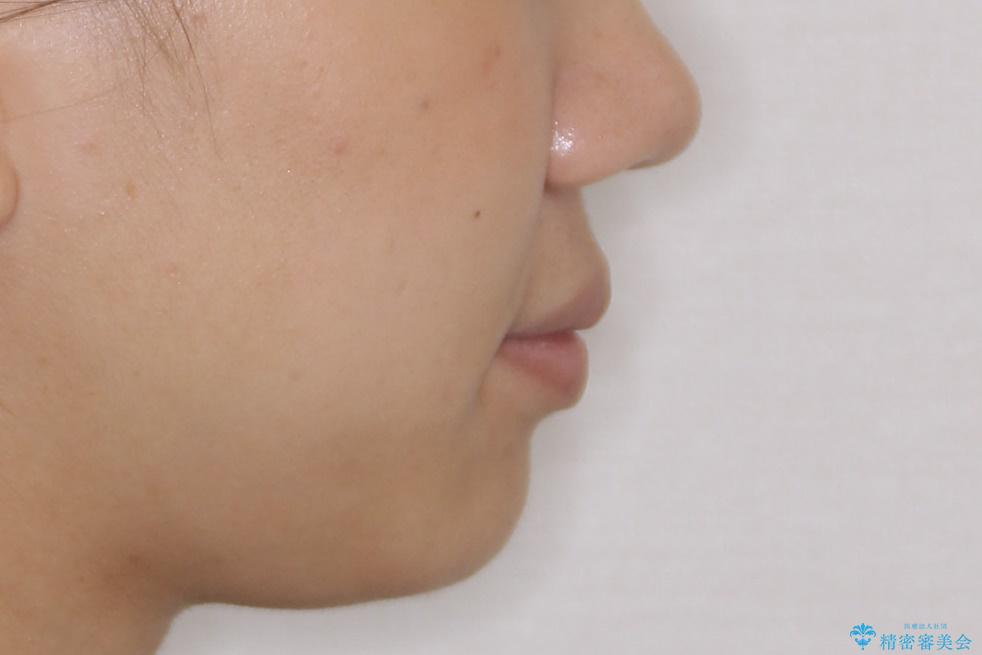 横顔をすっきりさせたい 下の前歯が1本少ない方の変則的な抜歯矯正の治療前(顔貌)