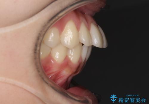 横顔をすっきりさせたい 下の前歯が1本少ない方の変則的な抜歯矯正の治療前