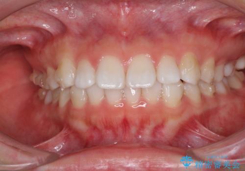 インビザラインによる軽度な出っ歯の矯正治療の治療中