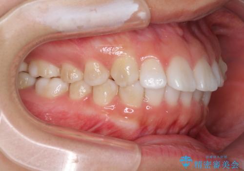 インビザラインによる軽度な出っ歯の矯正治療の治療中