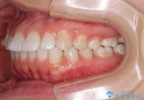 インビザラインによる軽度な出っ歯の矯正治療の治療中