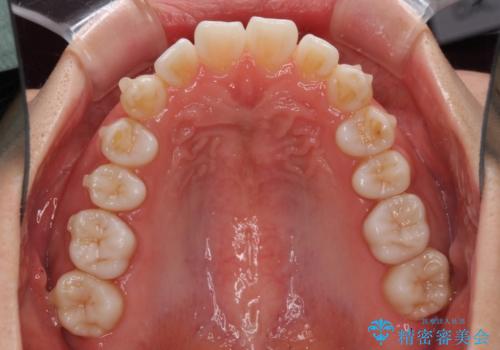 インビザラインによる軽度な出っ歯の矯正治療の治療中