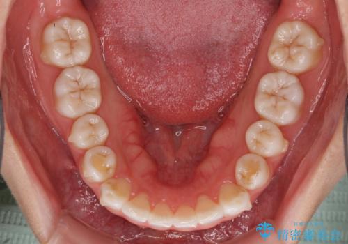 インビザラインによる軽度な出っ歯の矯正治療の治療中