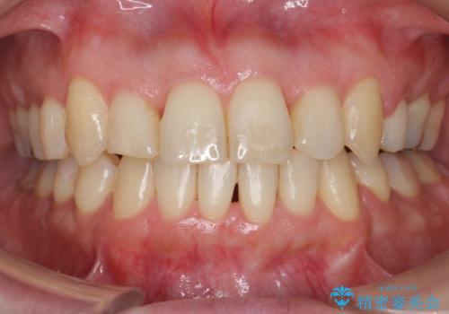 40代の矯正　八重歯を綺麗に　の症例 治療後