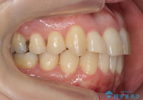 40代の矯正　八重歯を綺麗に　の治療後