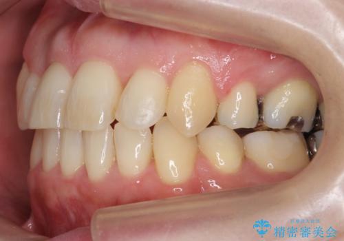 40代の矯正 八重歯を綺麗に の治療後