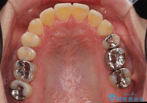 40代の矯正 八重歯を綺麗に の治療後