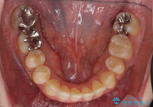 40代の矯正 八重歯を綺麗に の治療後