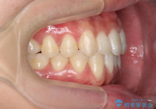 インビザライン矯正　神経のない歯をとって、全て天然歯に　の治療後