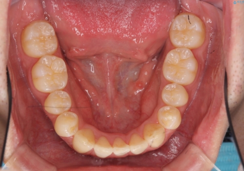 インビザライン矯正　神経のない歯をとって、全て天然歯に　の治療後